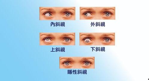 成人隐性斜视配镜视频,成人隐性斜视配镜技巧与视频解析